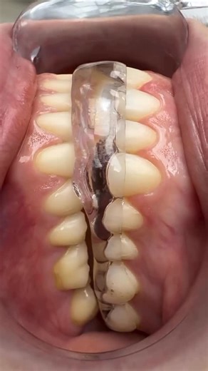 Dentistry blog on Instagram: "Bruxism management By • @enrique_diazguzman Splints (or night guards/mouthguards) are a common way to manage bruxism (teeth grinding/clenching) by protecting teeth from wear, reducing jaw/muscle pain, and unloading the temporomandibular joint (TMJ) by keeping teeth slightly apart."
