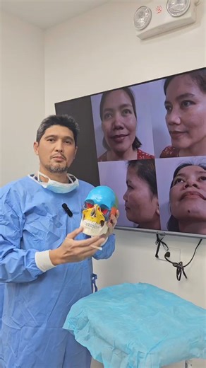 Osteotomy or breaking of nasal bone #claravclinic #osteotomy #rhinoplastyph #seamlessalar | Clara V Clinic