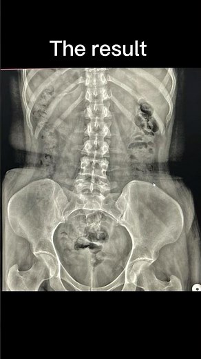 KUB XRAY POSITION #radiology#anatomy#medicalimaging#diagnosticimaging#xray#medicaltest#ct#doctor#due
