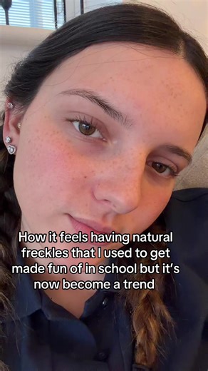 Embracing Natural Freckles: From Teasing to Trend