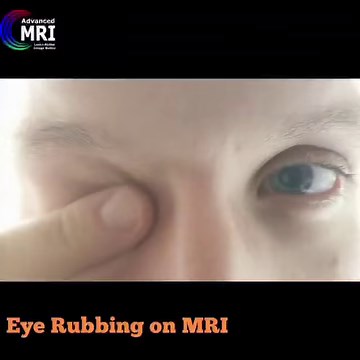 15K views · 38 reactions | Eye Rubbing on MRI Would you do that again? @advanced_mri_ #Brain_Metastasis #mri #mritech #mritechnologist #technologist #technology #pathology #radiology #radiologist #diagnosis #advanced_mri #advancedmri #mrilogy #eye #rubbing #hospital #ophthalmology #nueyecarett #nueyecare #ophthalmologist Reposted from @advanced_mri_ | NU Eye Care | Facebook