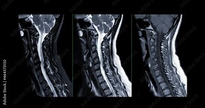 MRI C-spine or magnetic resonance image of cervical spine Axial , Coronal and sagittal plane showing spondylosis and compression fracture.
