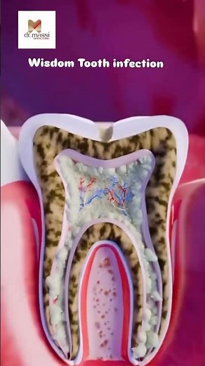 WISDOM TEETH INFECTION 🥴🦷