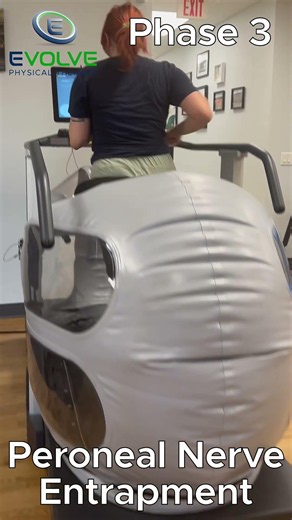 Microgravity Treadmill Running for Peroneal Nerve Entrapment Treatment