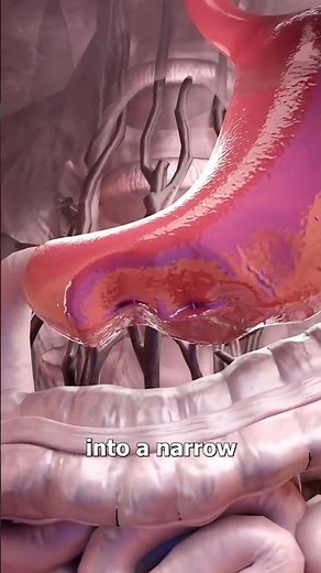 How stomach reduction surgery works?