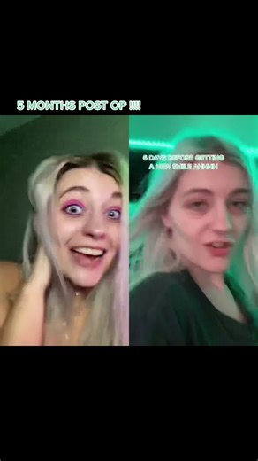 #duet with @softscorpio IM SO IN LPVE WITH MY SMILE THANK U GUYS SO MUCH #dentures #recovery #postop #denturegang #mentalhealth #denturesatayoungage