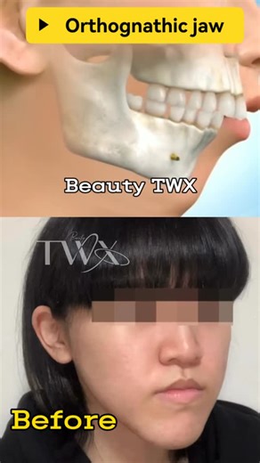 Mr.Davide on Instagram: "Comparison before and after orthognathic surgery for women! What do you think of the effect? #plastic #整形 #医美 #glowup #things #facelift"