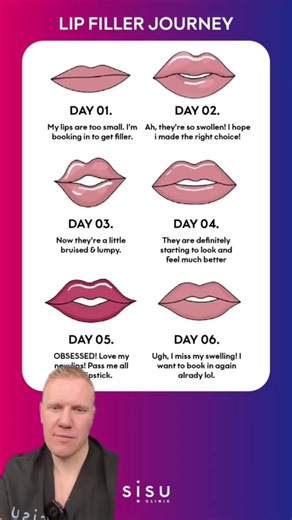 Thinking about lip fillers? 👄 This video is for YOU! Dr. Brian provides a complete guide to the lip filler journey, right from day 1. Watch to see the process, recovery, and amazing results! Still unsure? Book a FREE consultation with us click the link in bio or send us a DM to discuss your lip goals! #sisuclinic #lipfiller #lipfillerbeforeandafter #lipfillertreatment #lipfillertransformation #naturallooking #lips #aesthetics #dermalfillers #lipinjections #fillers #lipaugmentation #lipfillers #