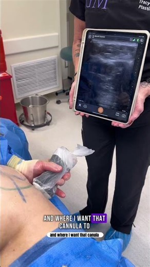 The BBL 🍑 but make it safe and stunning. #bbl #bblsafety #bestbblshape #brazilianbuttlift