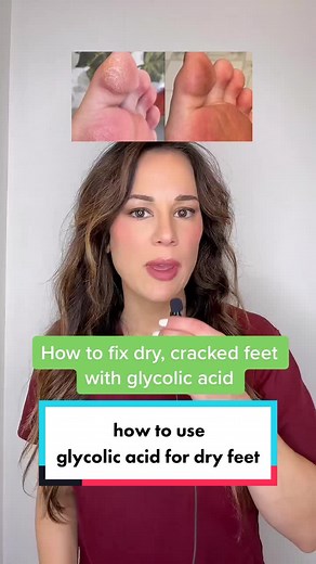 Effectively Using Glycolic Acid for Dry Cracked Feet
