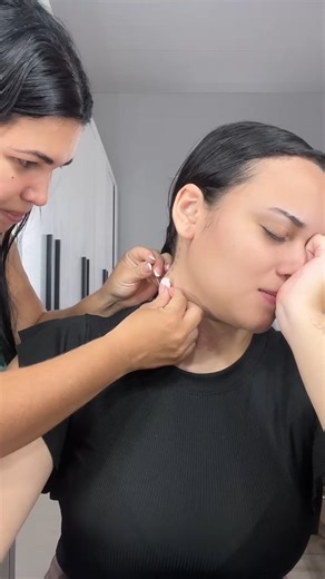 😳 It looked small, but wait till you see the ending! | Pimple Popping