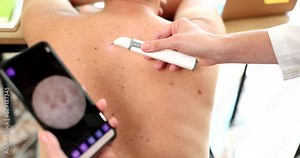 Doctor examining patient pigmented nevi using dermatoscope with mobile phone closeup 4k movie slow motion. Diagnosis and treatment of melanoma dermatoscopy concept