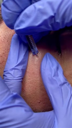 Effective Extractions for Clean, Glowing Skin