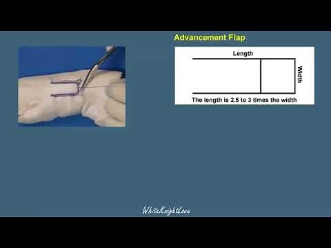 8 2 Advancement Flap Skin Flaps Essential Surgical Skills WhiteKnightLove