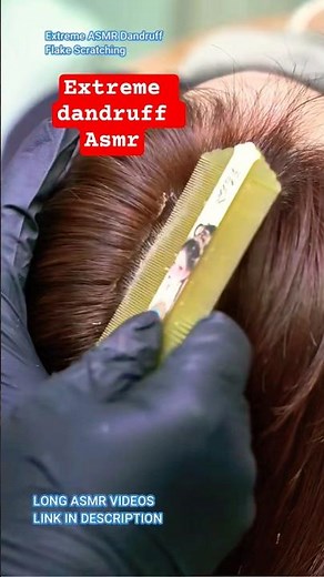 Extreme dandruff Asmr flakes scratching #asmrscalpscratching #asmrdandruffscratching #asmrscalp