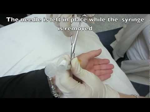 MCP Injection of the Left Thumb - Metacarpophalangeal Joint