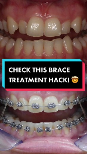 How To Change Rubber Bands on Braces Quickly and Easily