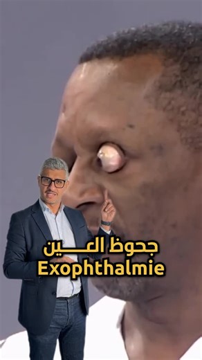 Zebbiche Imadeddine on Instagram‎: "جحوظ العين exophtalmie. . . . . . . . #جحوظ_العين #طبيب_عيون #الجزائر #alger #blida"‎