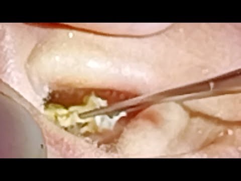 BÍ QUYẾT LẤY RÁY TAI AN TOÀN KHÔNG GÂY ĐAU | SAFE & GENTLE EAR CLEANING TIPS