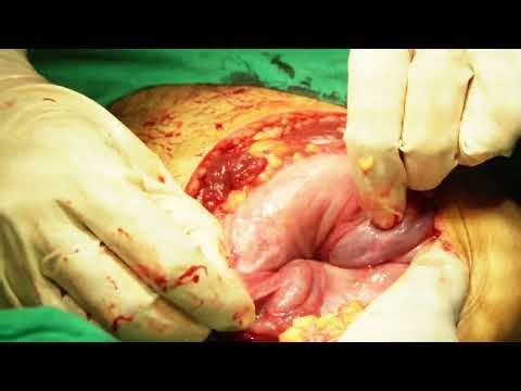 Uterine Inversion | Normal Delivery ke baad Uterus Palat Jaye to Kya Kare?