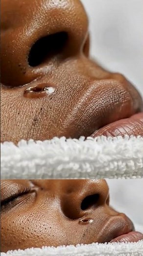 Nose Pore Recovery Pore Tightening Extraction ASMR