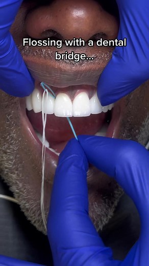 Flossing with Dental Bridge: Tips and Tricks