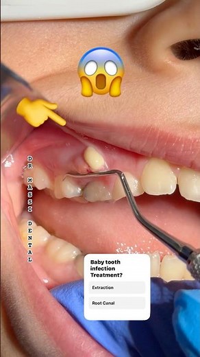 Baby Tooth Dental Abscess — Keep it or Remove it? 🦷❓