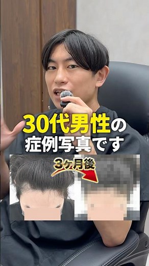 【薄毛治療症例】「髪のボリュームが年々減ってきた」方の治療紹介