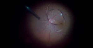Vitrectomy With Stand-up Technique for Dislocated IOL - Eyetube