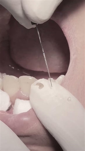 Tooth nerve pain #dentist