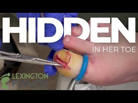 Hidden in Her Toe? | Infected Ingrown