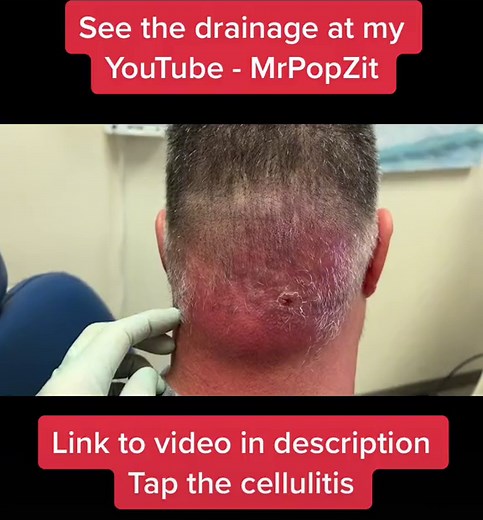Link to cellulitis drainage video on YouTube https://youtu.be/tXJCow_5M7k #dermatology #physicianassistant #dermatologypa #physicianassociate #mrpopzit #popaholic #popaholics #cyst #pimplepopping #cellulitus #abscess #abscesslancing #abscessdraining