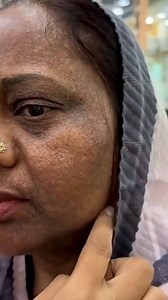 7Days Dark Spots, Melasma & Pigmentation Removal Challenge | Get Clear & Glowing Skin, Natural Skin Care #darkspots #pigmentation #clearskin #skincare #viralreelsfacebook #reelsfypシ | Health Beauty Treat