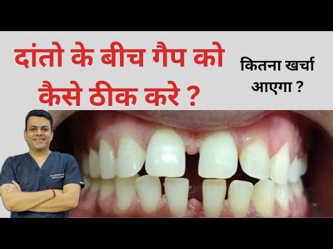 How to fix the gap between teeth and how much will it cost?