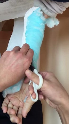 【佐渡市】ギプスのカットもお任せを！シーネ型（新潟県、佐渡市のしもざわ接骨院グループ、骨折、脱臼、捻挫などケガの治療、むち打ち症などの交通事故、ギプス固定、エコー検査、超音波）