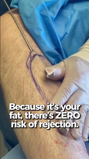 Calf Augmentation Surgery Using Fat Transfer | What to Expect