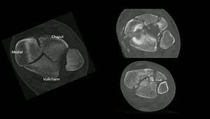 Tibial Pilon Fractures: Where and How to Fix