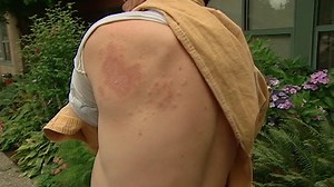 What is shingles - and how do you get it?