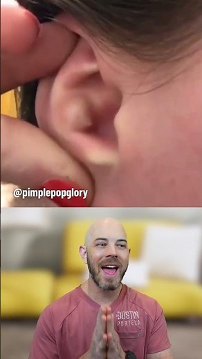 This ear cyst's pop is quite unique! (credit: @pimplepopglory on TT) #satisfying #fypシ