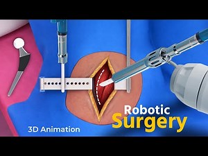 How Robotic Hip Replacement Surgery Actually Works | 3D Animation