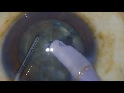 My 1st phaco with foldable iol implant upload keen observation is the key in learning process