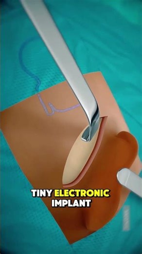 Cochlear Implant Surgery Explained