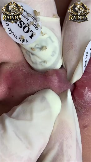 Vídeos satisfatórios, aqui tem! Me segue para mais vídeos satisfatórios! #foryoupage❤️❤️ #acnefighter #foryou #acnetreatment #pimples