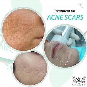 15K views · 280 reactions | Microneeedling RF with PRP. It really helps “Acne Scars”. The process promotes the growth of new collagen in your skin, encouraging your skin to heal itself. For appointments: UAN: 0304-1113666 DHA -- Tariq Road -- North Nazimabad. #acnescars #MicroneedlingRF #openpores #FaceScars #Scars #drshaistalodhi #theaestheticsclinic #shaistalodhi #acnea | The Aesthetics Clinic | Facebook