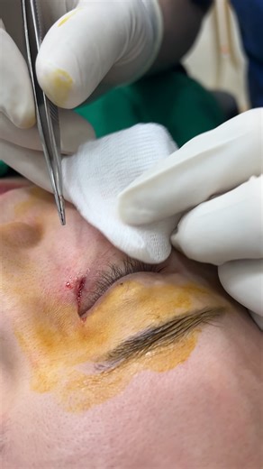 Thread lifting remove (under eye)