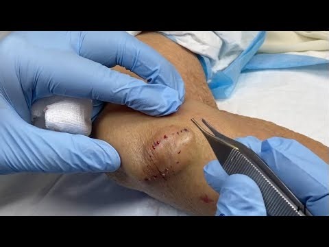 Doctor Removes Massive Epidermal Cyst from Elbow Shocking Pus!