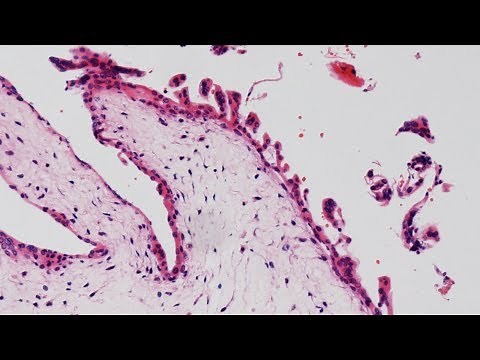 Partial Hydatidiform Mole - Pathology mini tutorial