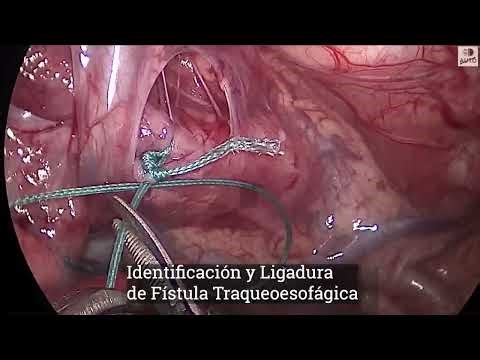 Atresia de esófago por toracoscopia