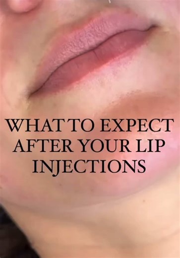Curious about enhancing your smile with a touch of glamour? Lip fillers might just be your answer! Discover what to know and how to make the most of this beauty upgrade. - 💋 Lip fillers offer that subtle yet stunning boost for a mesmerizing transformation. - 🧖‍♀️ Infused with naturally occurring hyaluronic acid, making them gentle on your skin. - 🤝 Choosing the right expert is like finding your beauty muse – it's a critical step. - 🗣️ Consult a specialist to understand the procedure, expecta