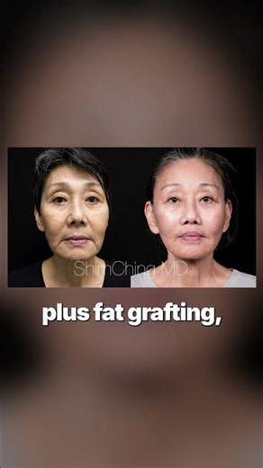 Which Facelift Is Right For You?